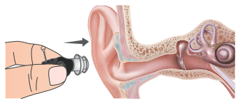 deafness hearing aids