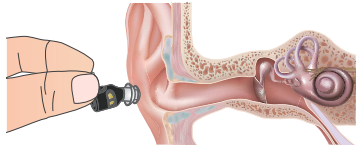 deafness hearing aids